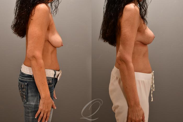 Breast Augmentation with Fat Transfer Case 1001762 Before & After Right Side | Serving Rochester, Syracuse & Buffalo, NY | Quatela Center for Plastic Surgery