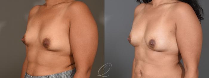 Breast Augmentation with Fat Transfer Case 1408 Before & After Left Oblique | Serving Rochester, Syracuse & Buffalo, NY | Quatela Center for Plastic Surgery