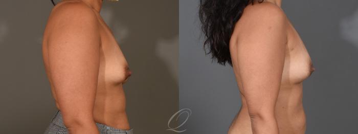 Breast Augmentation with Fat Transfer Case 1408 Before & After Right Side | Serving Rochester, Syracuse & Buffalo, NY | Quatela Center for Plastic Surgery