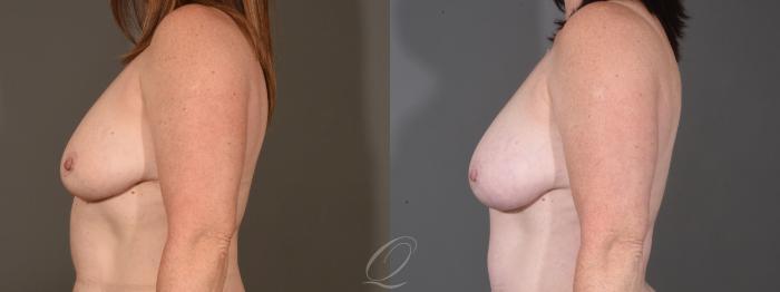 Breast Augmentation with Fat Transfer Case 1409 Before & After Left Side | Serving Rochester, Syracuse & Buffalo, NY | Quatela Center for Plastic Surgery
