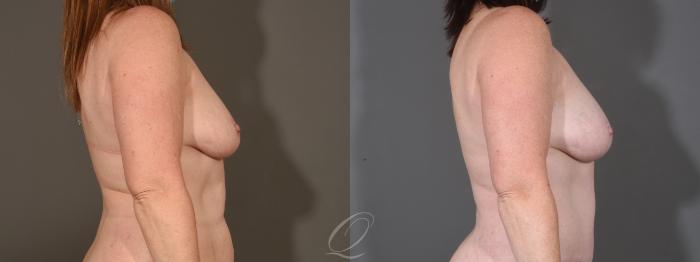Breast Augmentation with Fat Transfer Case 1409 Before & After Right Side | Serving Rochester, Syracuse & Buffalo, NY | Quatela Center for Plastic Surgery
