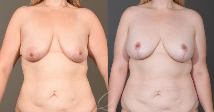 Breast Augmentation with Lift Case 1001604 Before & After Front | Serving Rochester, Syracuse & Buffalo, NY | Quatela Center for Plastic Surgery