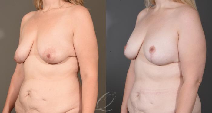Breast Augmentation with Lift Case 1001604 Before & After Left Oblique | Serving Rochester, Syracuse & Buffalo, NY | Quatela Center for Plastic Surgery
