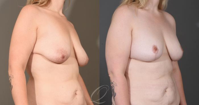 Breast Augmentation with Lift Case 1001604 Before & After Right Oblique | Serving Rochester, Syracuse & Buffalo, NY | Quatela Center for Plastic Surgery