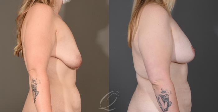 Breast Augmentation with Lift Case 1001604 Before & After Right Side | Serving Rochester, Syracuse & Buffalo, NY | Quatela Center for Plastic Surgery
