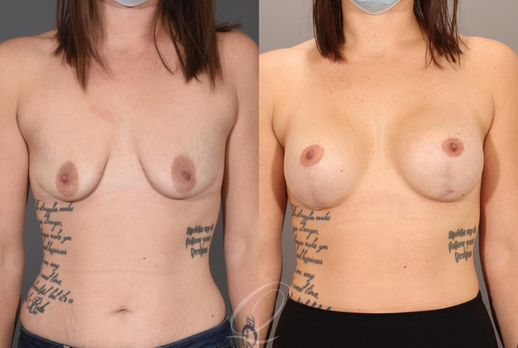 Breast Augmentation with Lift Case 1001605 Before & After Front | Serving Rochester, Syracuse & Buffalo, NY | Quatela Center for Plastic Surgery