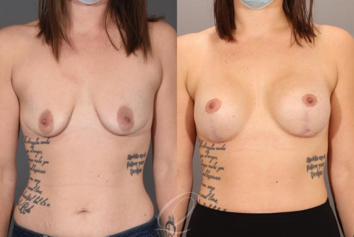 Breast Augmentation with Lift Case 1001605 Before & After Front | Serving Rochester, Syracuse & Buffalo, NY | Quatela Center for Plastic Surgery