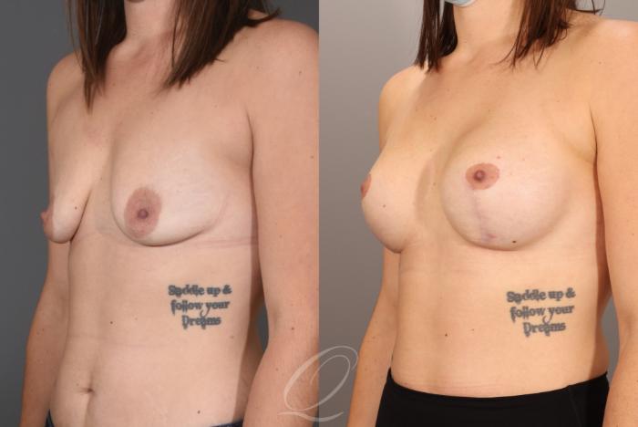 Breast Augmentation with Lift Case 1001605 Before & After Left Oblique | Serving Rochester, Syracuse & Buffalo, NY | Quatela Center for Plastic Surgery