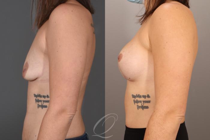 Breast Augmentation with Lift Case 1001605 Before & After Left Side | Serving Rochester, Syracuse & Buffalo, NY | Quatela Center for Plastic Surgery