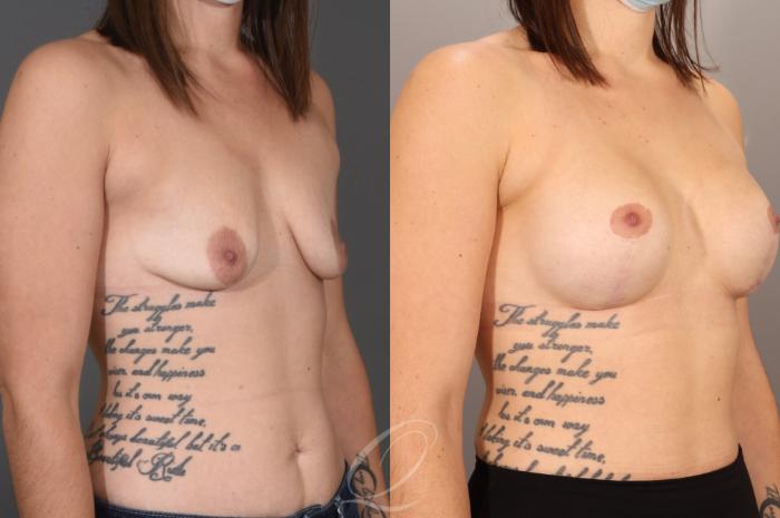 Breast Augmentation with Lift Case 1001605 Before & After Right Oblique | Serving Rochester, Syracuse & Buffalo, NY | Quatela Center for Plastic Surgery