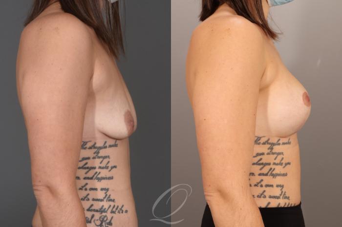 Breast Augmentation with Lift Case 1001605 Before & After Right Side | Serving Rochester, Syracuse & Buffalo, NY | Quatela Center for Plastic Surgery