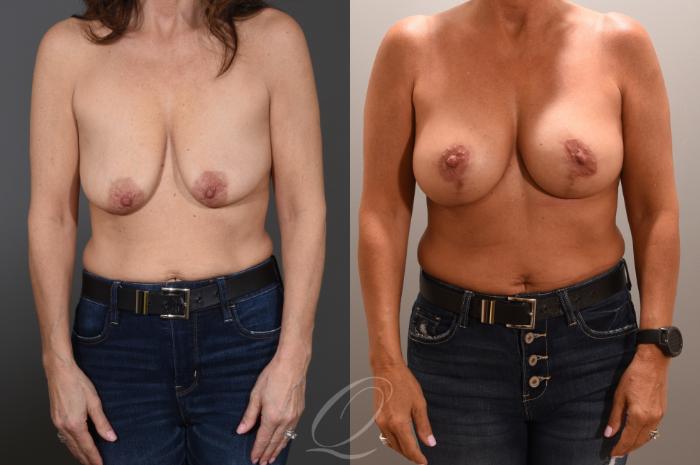 Breast Augmentation with Lift Case 1001606 Before & After Front | Serving Rochester, Syracuse & Buffalo, NY | Quatela Center for Plastic Surgery