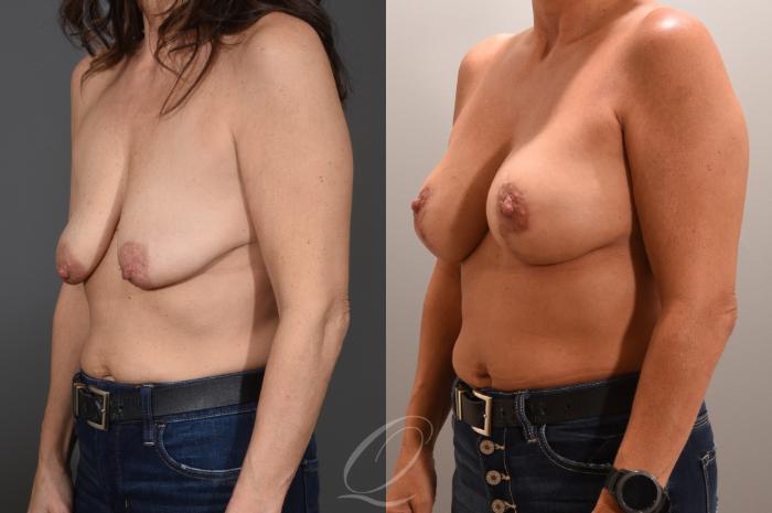 Breast Augmentation with Lift Case 1001606 Before & After Left Oblique | Serving Rochester, Syracuse & Buffalo, NY | Quatela Center for Plastic Surgery