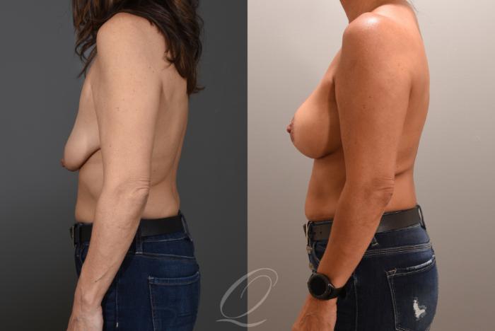 Breast Augmentation with Lift Case 1001606 Before & After Left Side | Serving Rochester, Syracuse & Buffalo, NY | Quatela Center for Plastic Surgery