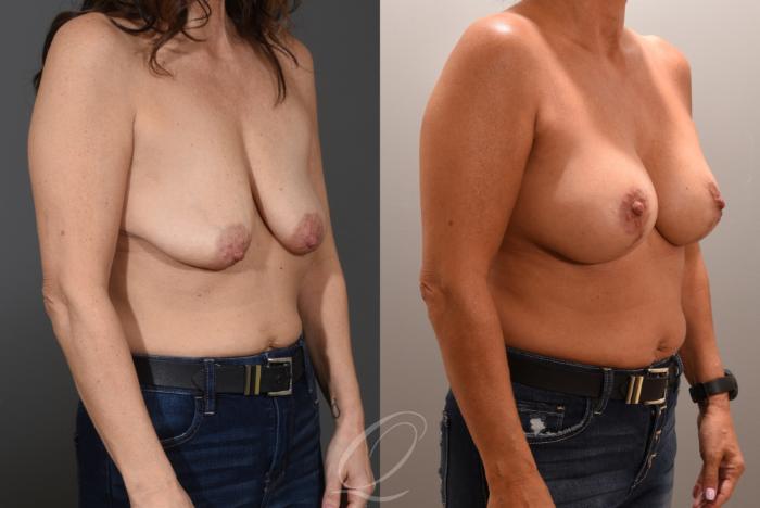 Breast Augmentation with Lift Case 1001606 Before & After Right Oblique | Serving Rochester, Syracuse & Buffalo, NY | Quatela Center for Plastic Surgery
