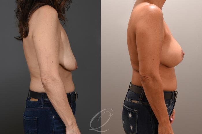 Breast Augmentation with Lift Case 1001606 Before & After Right Side | Serving Rochester, Syracuse & Buffalo, NY | Quatela Center for Plastic Surgery