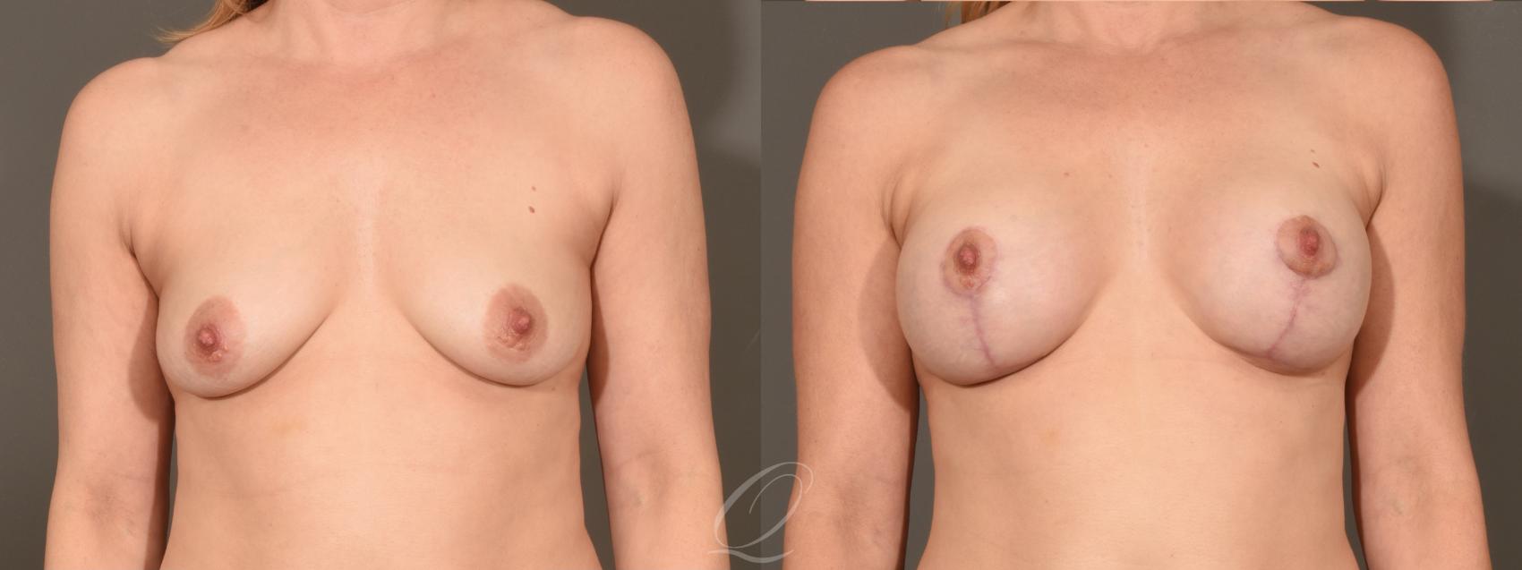 Breast Augmentation with Lift Case 1001609 Before & After Front | Serving Rochester, Syracuse & Buffalo, NY | Quatela Center for Plastic Surgery