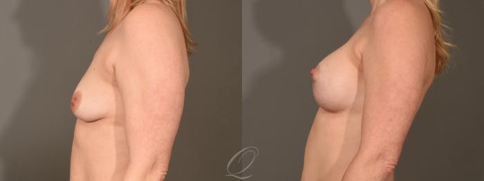 Breast Augmentation with Lift Case 1001609 Before & After Left Side | Serving Rochester, Syracuse & Buffalo, NY | Quatela Center for Plastic Surgery