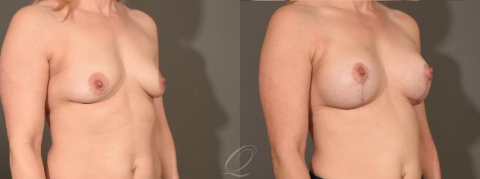 Breast Augmentation with Lift Case 1001609 Before & After Right Oblique | Serving Rochester, Syracuse & Buffalo, NY | Quatela Center for Plastic Surgery