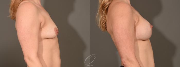 Breast Augmentation with Lift Case 1001609 Before & After Right Side | Serving Rochester, Syracuse & Buffalo, NY | Quatela Center for Plastic Surgery