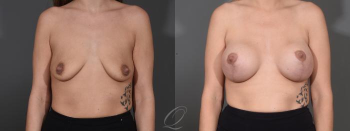 Breast Augmentation with Lift Case 1001610 Before & After Front | Serving Rochester, Syracuse & Buffalo, NY | Quatela Center for Plastic Surgery