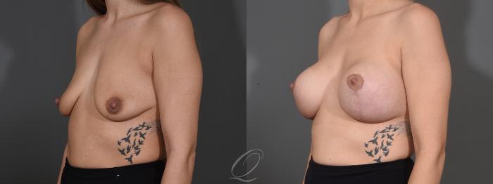 Breast Augmentation with Lift Case 1001610 Before & After Left Oblique | Serving Rochester, Syracuse & Buffalo, NY | Quatela Center for Plastic Surgery
