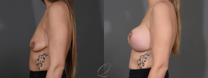 Breast Augmentation with Lift Case 1001610 Before & After Left Side | Serving Rochester, Syracuse & Buffalo, NY | Quatela Center for Plastic Surgery