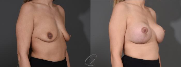Breast Augmentation with Lift Case 1001610 Before & After Right Oblique | Serving Rochester, Syracuse & Buffalo, NY | Quatela Center for Plastic Surgery