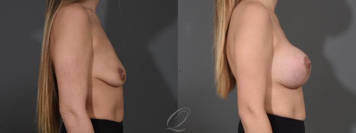 Breast Augmentation with Lift Case 1001610 Before & After Right Side | Serving Rochester, Syracuse & Buffalo, NY | Quatela Center for Plastic Surgery