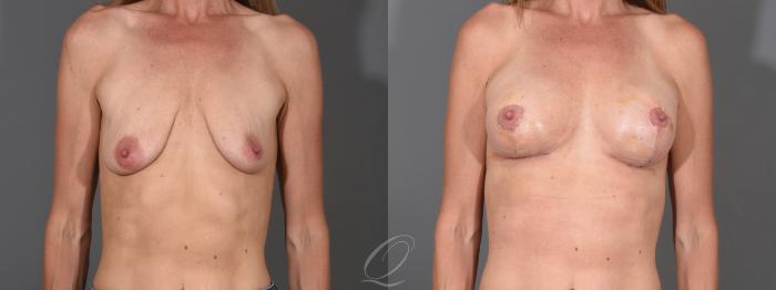 Breast Augmentation with Lift Case 1001611 Before & After Front | Serving Rochester, Syracuse & Buffalo, NY | Quatela Center for Plastic Surgery