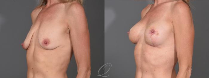 Breast Augmentation with Fat Transfer Case 1001611 Before & After Left Oblique | Serving Rochester, Syracuse & Buffalo, NY | Quatela Center for Plastic Surgery