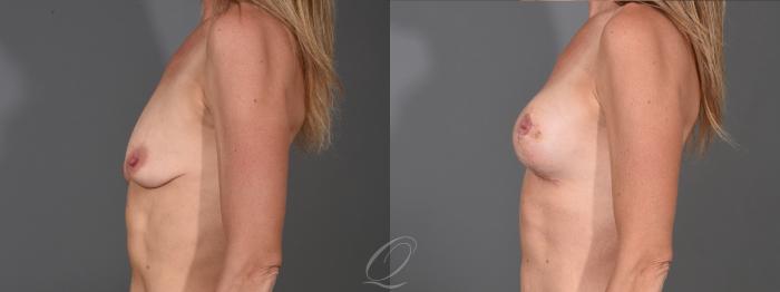 Breast Augmentation with Fat Transfer Case 1001611 Before & After Left Side | Serving Rochester, Syracuse & Buffalo, NY | Quatela Center for Plastic Surgery