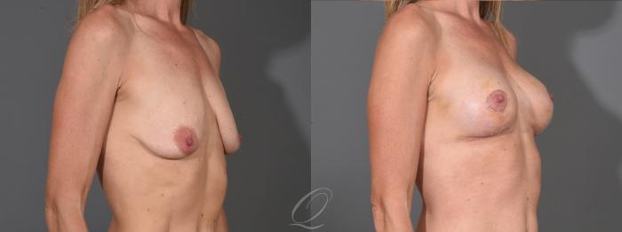 Breast Augmentation with Fat Transfer Case 1001611 Before & After Right Oblique | Serving Rochester, Syracuse & Buffalo, NY | Quatela Center for Plastic Surgery
