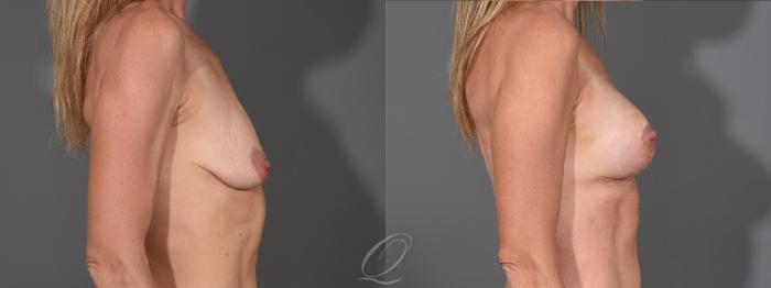 Breast Augmentation with Fat Transfer Case 1001611 Before & After Right Side | Serving Rochester, Syracuse & Buffalo, NY | Quatela Center for Plastic Surgery