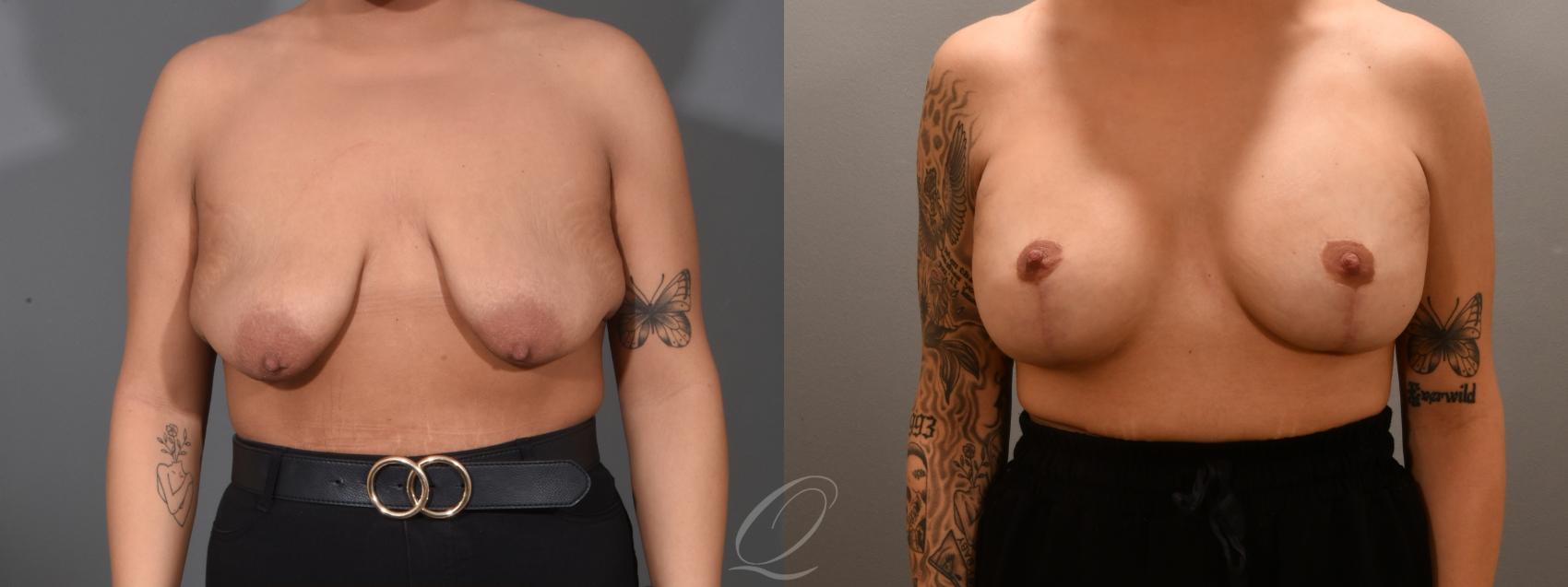 Breast Augmentation with Lift Case 1001618 Before & After Front | Serving Rochester, Syracuse & Buffalo, NY | Quatela Center for Plastic Surgery