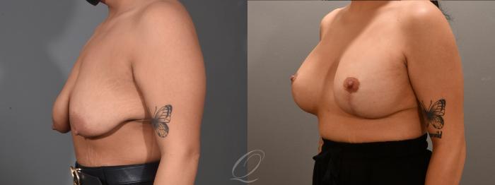 Breast Augmentation with Lift Case 1001618 Before & After Left Oblique | Serving Rochester, Syracuse & Buffalo, NY | Quatela Center for Plastic Surgery