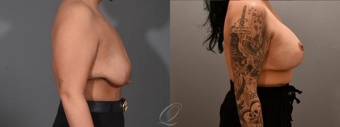 Breast Augmentation with Lift Case 1001618 Before & After Right Side | Serving Rochester, Syracuse & Buffalo, NY | Quatela Center for Plastic Surgery