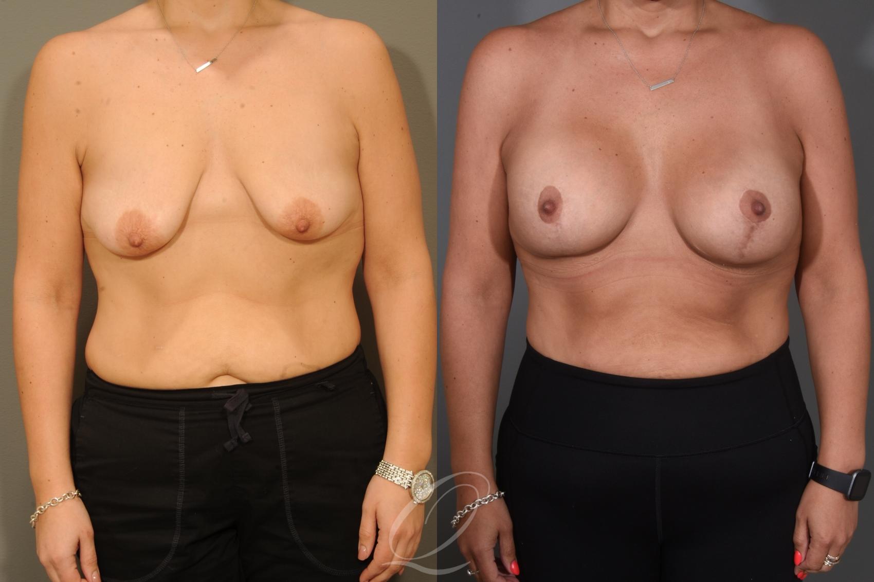 Breast Augmentation with Lift Case 1001654 Before & After Front | Serving Rochester, Syracuse & Buffalo, NY | Quatela Center for Plastic Surgery