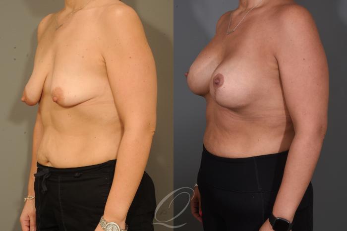 Breast Augmentation with Lift Case 1001654 Before & After Left Oblique | Serving Rochester, Syracuse & Buffalo, NY | Quatela Center for Plastic Surgery