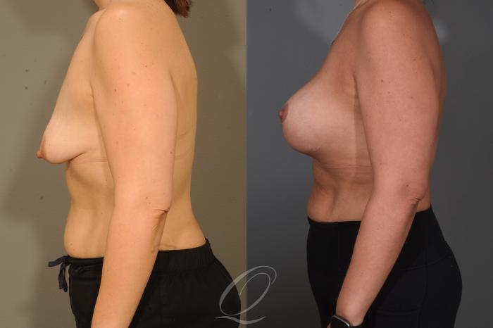 Breast Augmentation with Lift Case 1001654 Before & After Left Side | Serving Rochester, Syracuse & Buffalo, NY | Quatela Center for Plastic Surgery