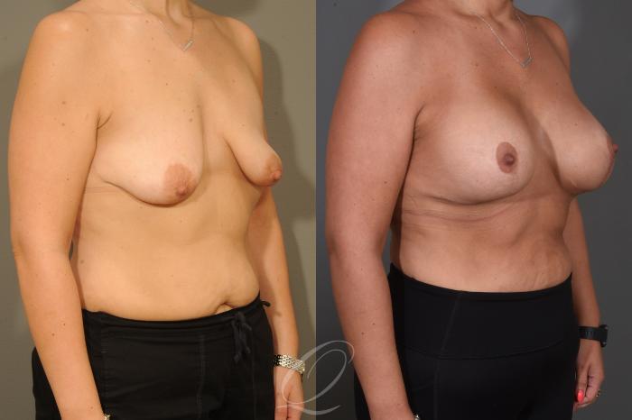 Breast Augmentation with Lift Case 1001654 Before & After Right Oblique | Serving Rochester, Syracuse & Buffalo, NY | Quatela Center for Plastic Surgery