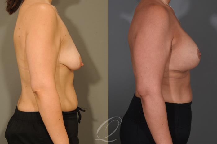 Breast Augmentation with Lift Case 1001654 Before & After Right Side | Serving Rochester, Syracuse & Buffalo, NY | Quatela Center for Plastic Surgery