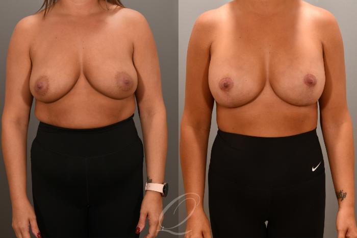 Breast Augmentation with Lift Case 1001661 Before & After Front | Serving Rochester, Syracuse & Buffalo, NY | Quatela Center for Plastic Surgery