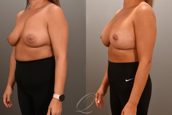 Breast Augmentation with Lift Case 1001661 Before & After Left Oblique | Serving Rochester, Syracuse & Buffalo, NY | Quatela Center for Plastic Surgery