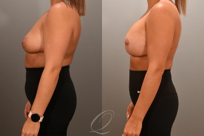 Breast Augmentation with Lift Case 1001661 Before & After Left Side | Serving Rochester, Syracuse & Buffalo, NY | Quatela Center for Plastic Surgery