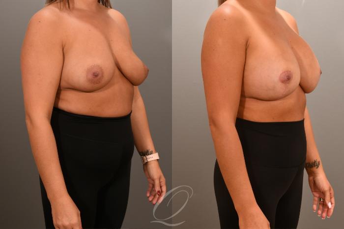 Breast Augmentation with Lift Case 1001661 Before & After Right Oblique | Serving Rochester, Syracuse & Buffalo, NY | Quatela Center for Plastic Surgery