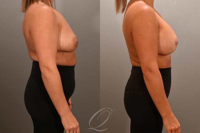Breast Augmentation with Lift Case 1001661 Before & After Right Side | Serving Rochester, Syracuse & Buffalo, NY | Quatela Center for Plastic Surgery
