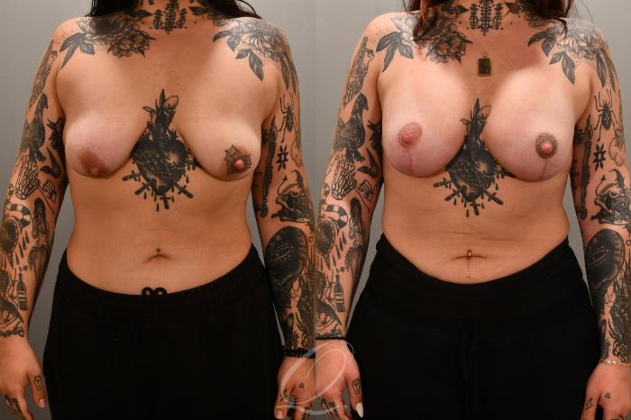 Breast Augmentation with Lift Case 1001717 Before & After Front | Serving Rochester, Syracuse & Buffalo, NY | Quatela Center for Plastic Surgery