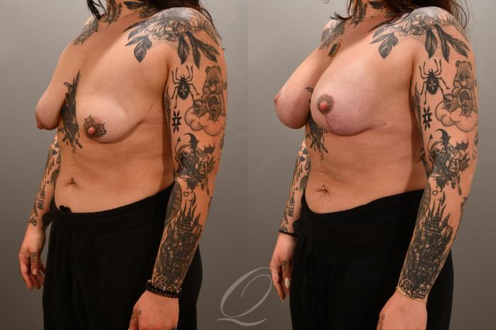 Breast Augmentation with Lift Case 1001717 Before & After Left Oblique | Serving Rochester, Syracuse & Buffalo, NY | Quatela Center for Plastic Surgery