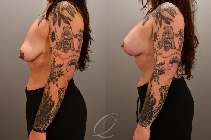 Breast Augmentation with Lift Case 1001717 Before & After Left Side | Serving Rochester, Syracuse & Buffalo, NY | Quatela Center for Plastic Surgery